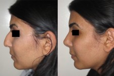 Primary-Rhinoplasty-BIG