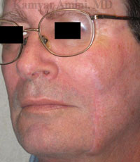 Cheek-large-B