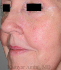 Cheek-small-2-B