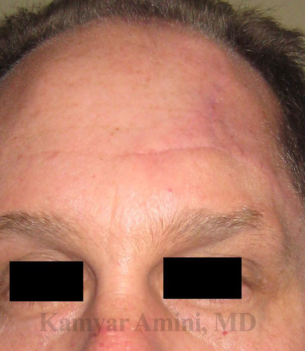 Forehead-large-3-A.jpg