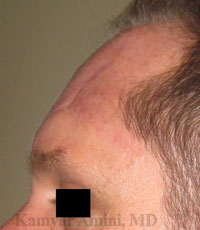 Forehead-large-5-B