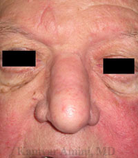Full-nasal-dorsum-2-B