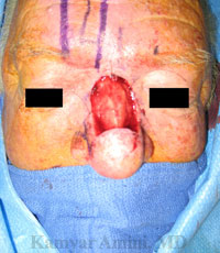 Full-nasal-dorsum-B