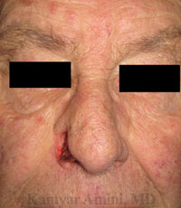 Full-nostril-2-B