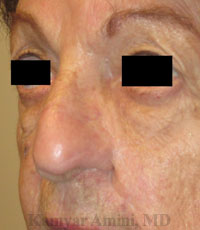Large-Nose-Cheek-B