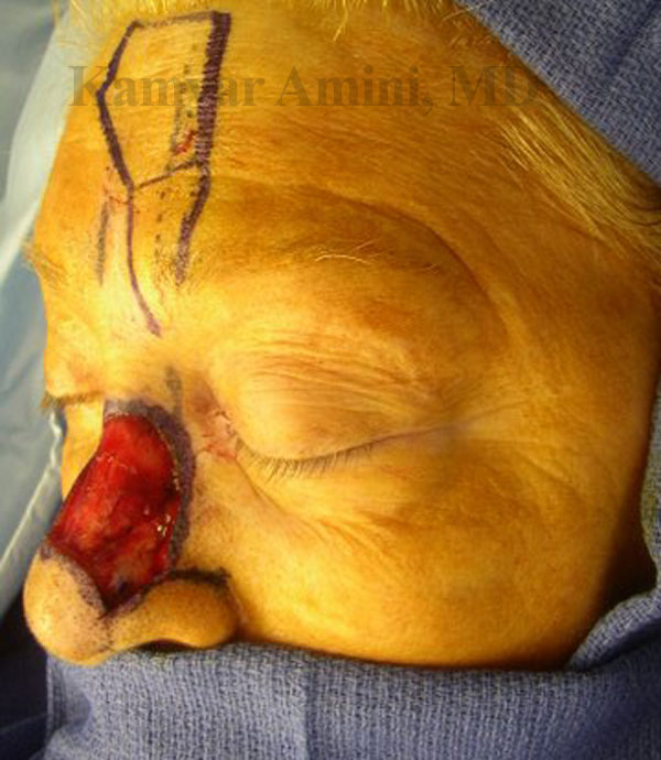 Nasal-Top-and-Side-3-A.jpg