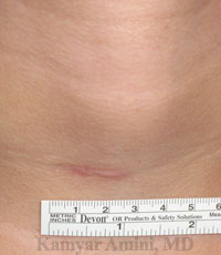 Parathyroid-20sB