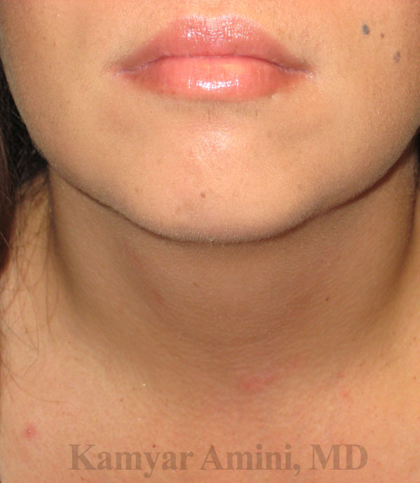 Parathyroid-40s-3A.jpg