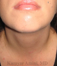 Parathyroid-40sB