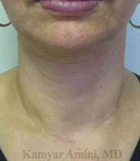 Parathyroid-50sB