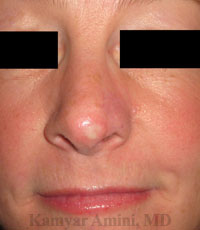 Partial-tip-3-B.jpg