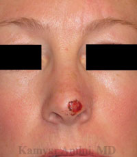 Partial-tip-B