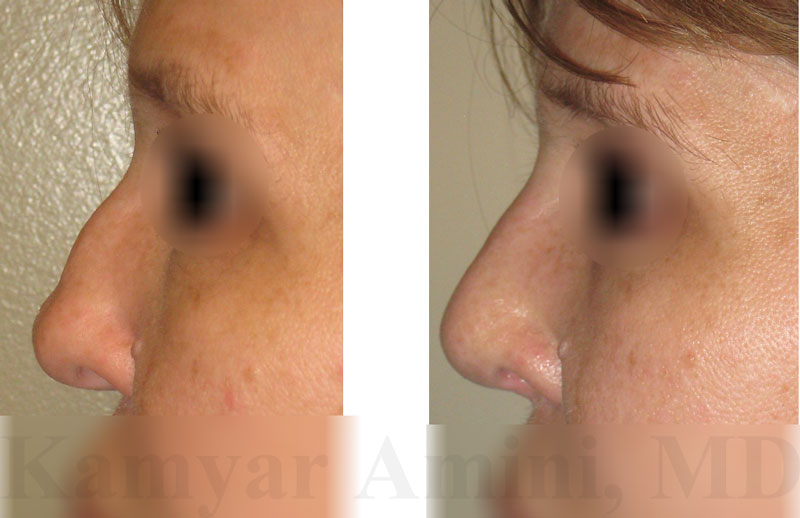 Rhinoplasty_ent_doctors_LA
