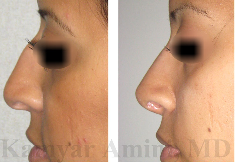 Rhinoplasty