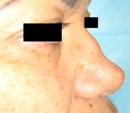 Septoplasty-at-ENT-Doctor-3