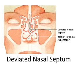 Septoplasty-ENT-Doctor LA