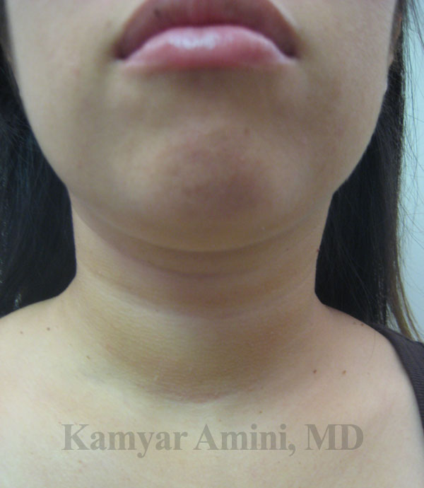 Thyroid-20s-3A.jpg