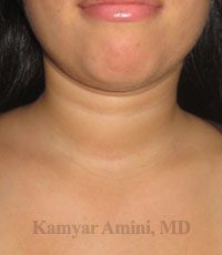 Thyroid-20s-4B