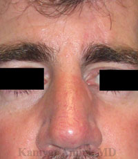 Upper-Nasal-Sidewall-2-B