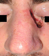 Upper-Nasal-Sidewall-5-B
