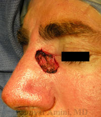 Upper-Nasal-Sidewall-B