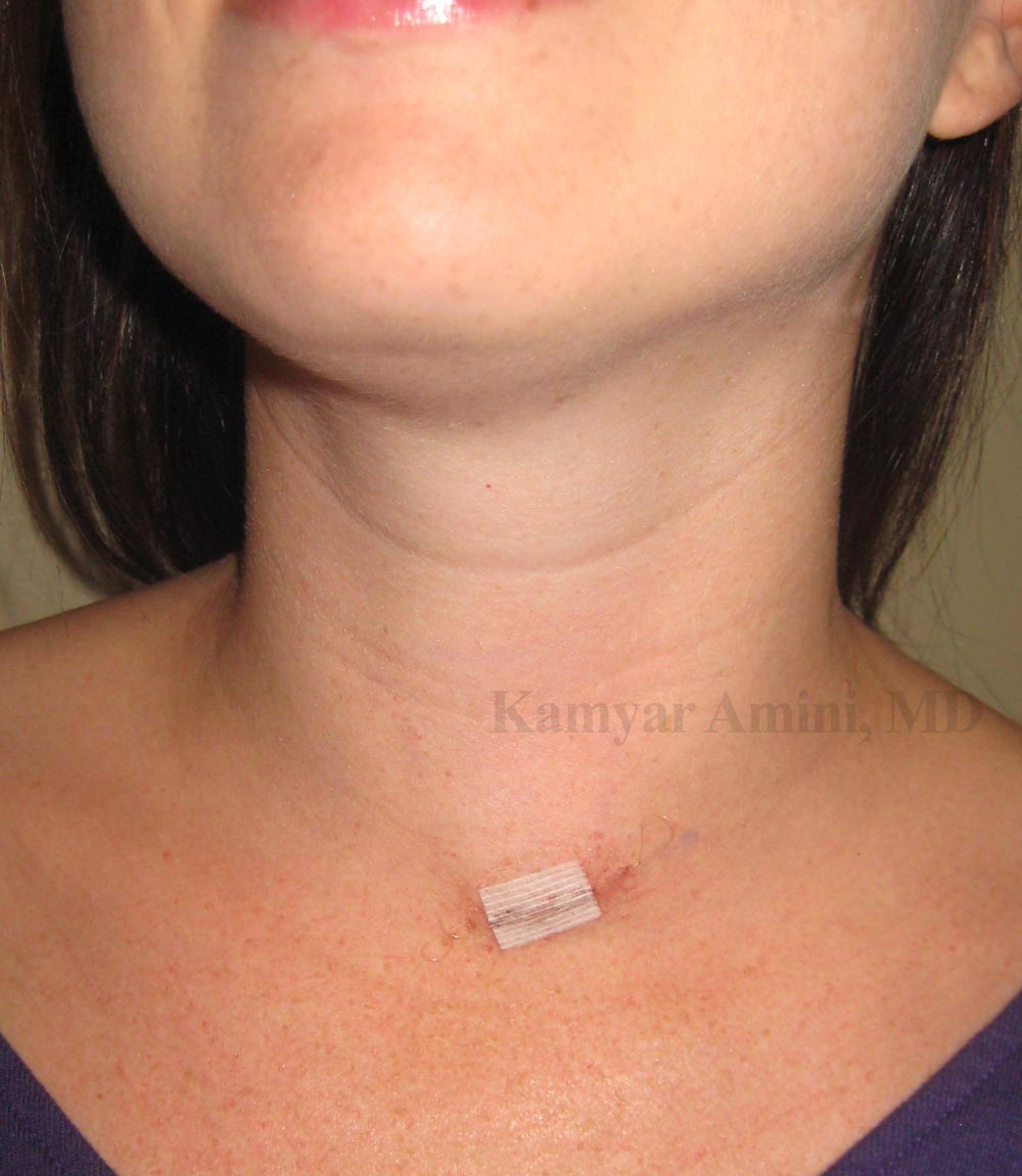 Immediate postoperative parathyroid