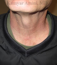 thyroid1-B