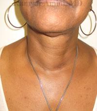 thyroid3-B